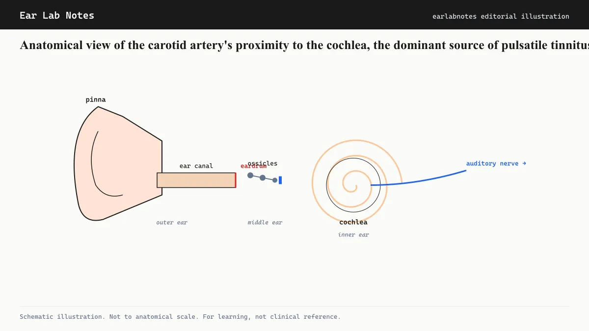 Anatomical view of the carotid artery's proximity to the cochlea, the dominant source of pulsatile tinnitus.